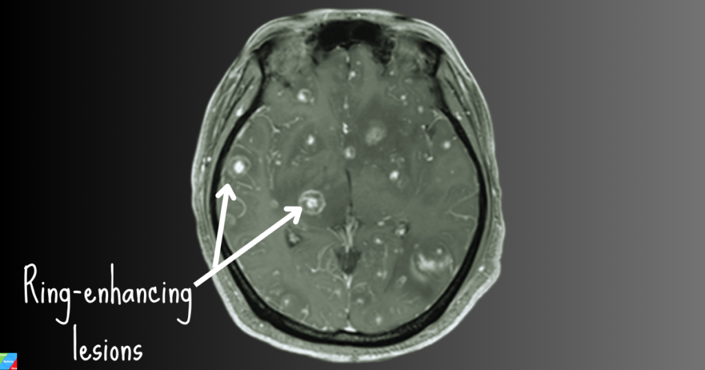 Cerebral ring-enhancing lesion of toxoplasmosis